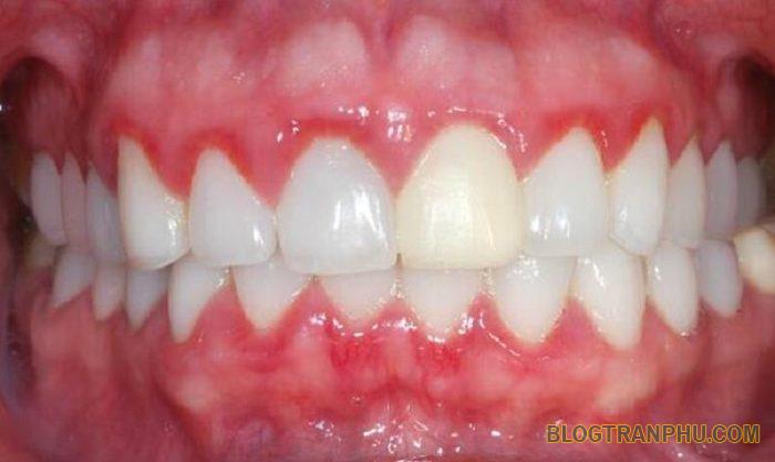 Biểu hiện bất thường sau khi bọc răng sứ NGUY HIỂM bạn nên biết