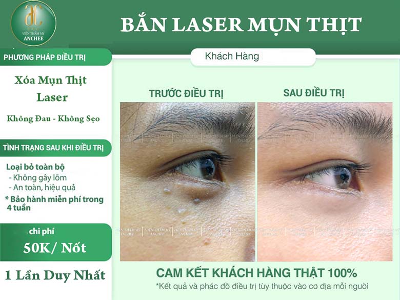 Đốt mụn thịt là công nghệ gì, có hiệu quả không?