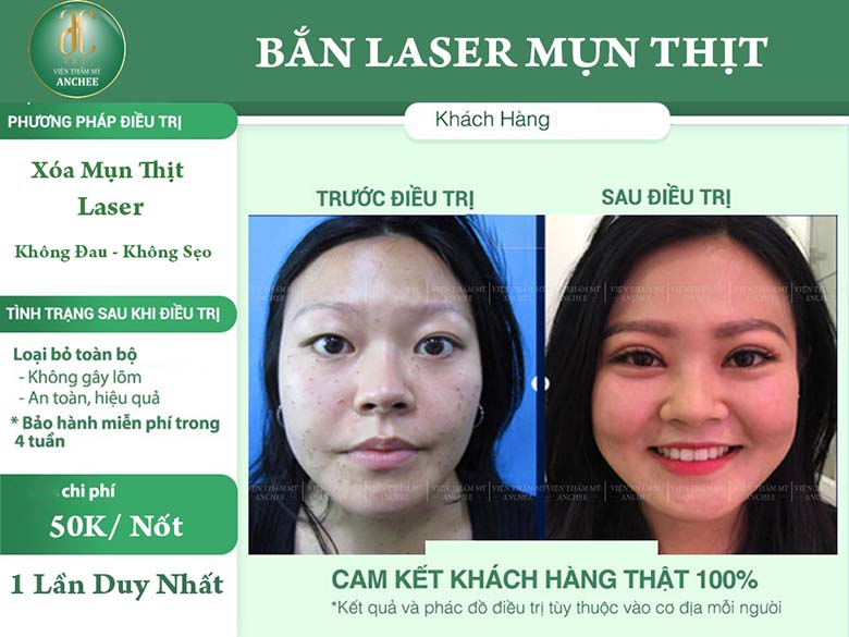 Đốt mụn thịt là công nghệ gì, có hiệu quả không?