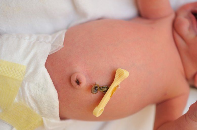 Dấu hiệu bé sắp rụng rốn và cách chăm sóc cuống rốn đúng cách