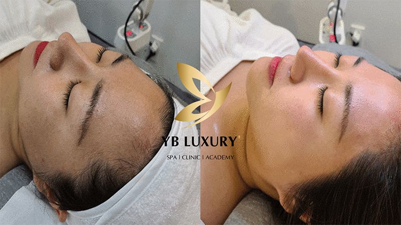 Triệt lông vừa sạch vừa có thể tiết kiệm chi phí tại YB Spa có thật không?