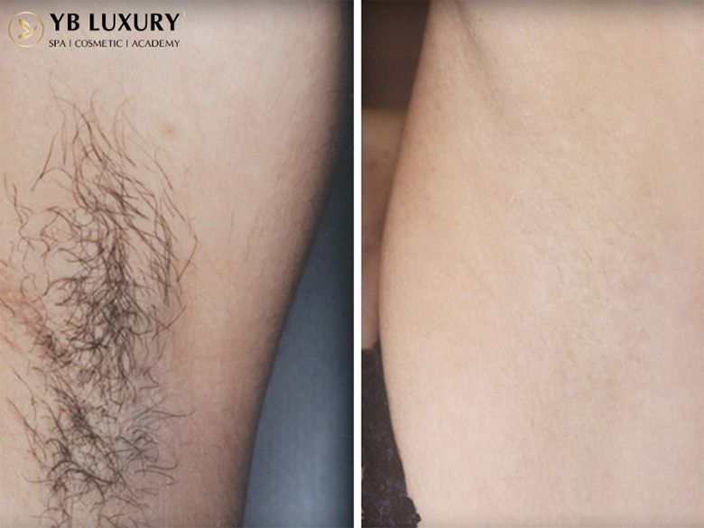 Triệt lông vừa sạch vừa có thể tiết kiệm chi phí tại YB Spa có thật không?