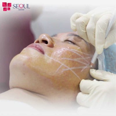 Căng da mặt là gì? Nên căng da mặt ở đâu đẹp và an toàn?