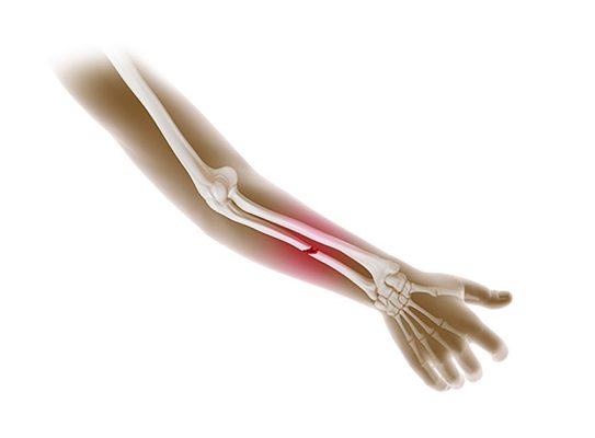 Gãy xương tay bao lâu thì lành?